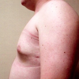 Male Breast Reduction Patient Photo - Case 1126 - after view-1