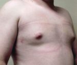 Male Breast Reduction - Case 1126 - After