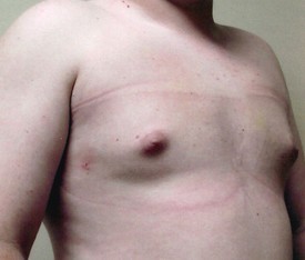 Male Breast Reduction Patient Photo - Case 1126 - after view