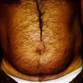 Liposuction Patient Photo - Case 1144 - before view-