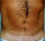 Liposuction - Case 1144 - After