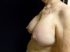 Breast Implant Removal Patient Photo - Case 1020 - after view-1