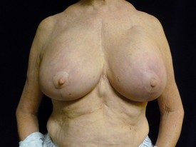 Breast Implant Removal - Case 1020 - After