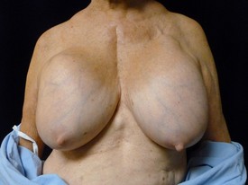 Breast Implant Removal Patient Photo - Case 1020 - before view-0