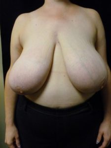 Breast Reduction - Case 1051 - Before