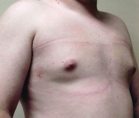 Liposuction Patient Photo - Case 1147 - after view