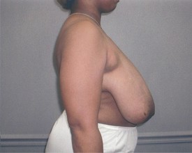 Breast Reduction Patient Photo - Case 1056 - before view-1