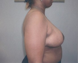 Breast Reduction Patient Photo - Case 1056 - after view-1
