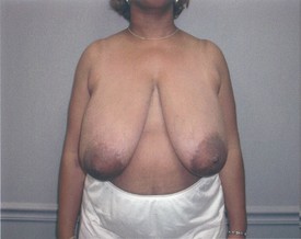 Breast Reduction Patient Photo - Case 1056 - before view-