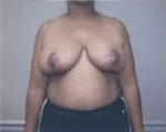 Breast Reduction - Case 1056 - After