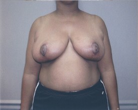 Breast Reduction Patient Photo - Case 1056 - after view
