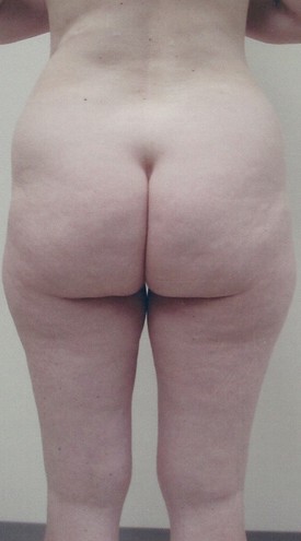 Liposuction Patient Photo - Case 1152 - after view-1