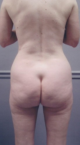 Liposuction Patient Photo - Case 1152 - before view-1