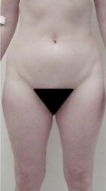 Liposuction - Case 1152 - After