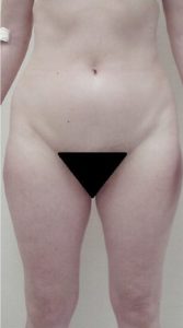 Liposuction - Case 1152 - After