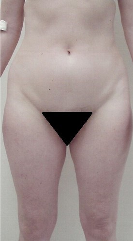 Liposuction Patient Photo - Case 1152 - after view