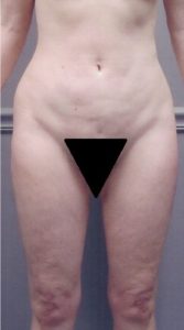 Liposuction - Case 1152 - Before