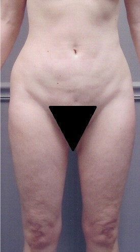 Liposuction Patient Photo - Case 1152 - before view-