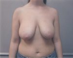 Breast Reduction - Case 1061 - Before