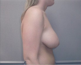 Breast Reduction Patient Photo - Case 1061 - before view-1