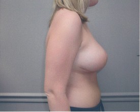 Breast Reduction Patient Photo - Case 1061 - after view-1