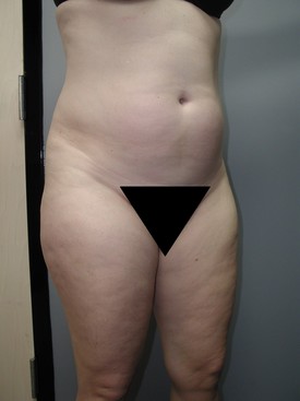Liposuction Patient Photo - Case 1157 - before view-
