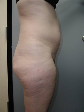 Liposuction Patient Photo - Case 1157 - before view-1