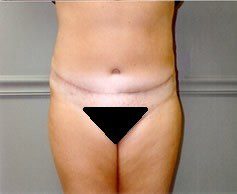 Tummy Tuck Patient Photo - Case 1177 - after view-0