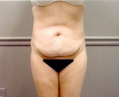 Tummy Tuck - Case 1177 - Before