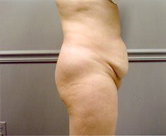 Tummy Tuck Patient Photo - Case 1177 - before view-1