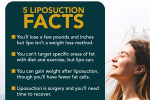 5 Liposuction Facts Infographic thumb