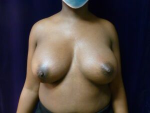 Breast Augmentation - Case 1946 - After