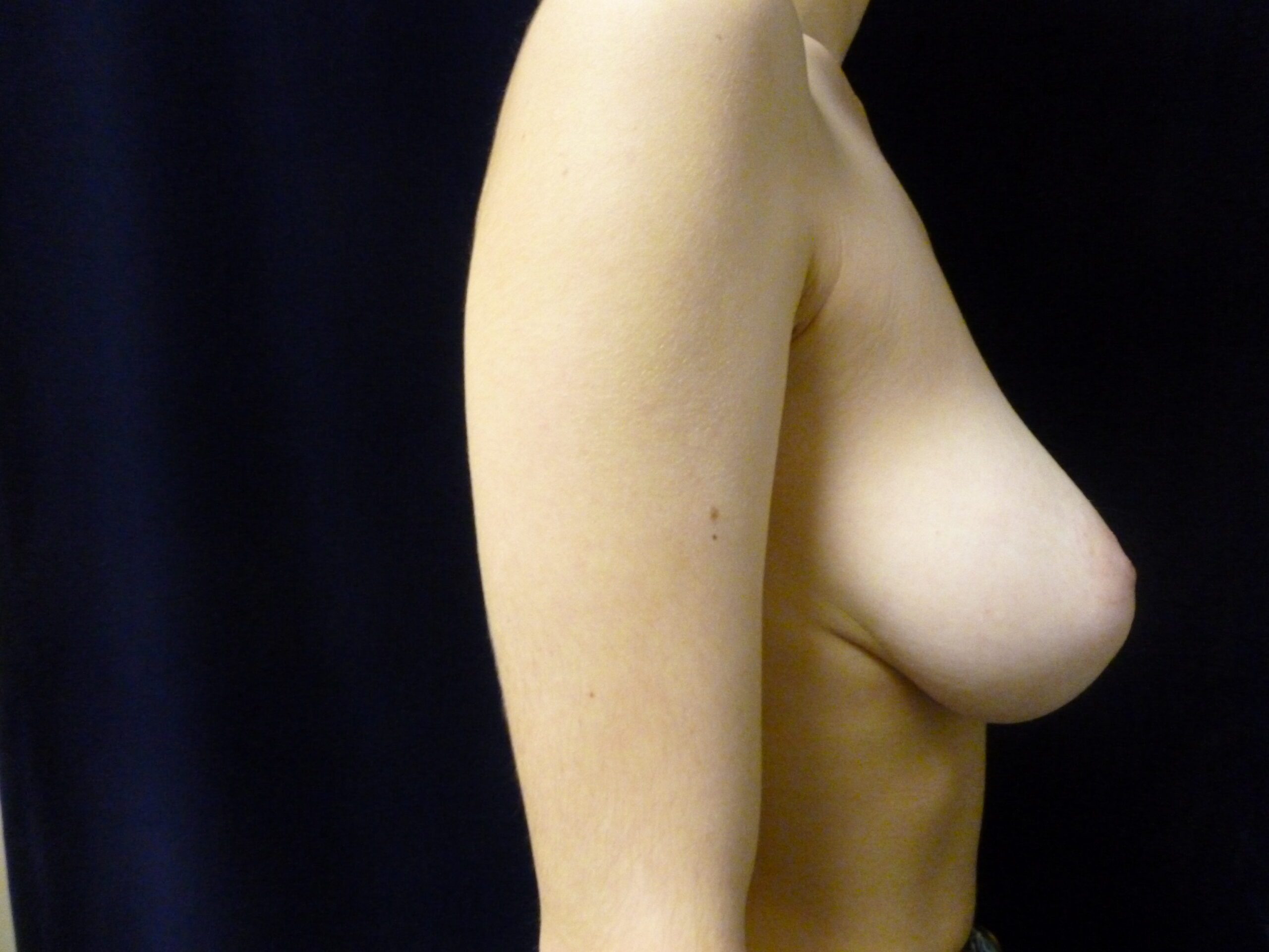 Breast Lift Patient Photo - Case 1958 - before view-2