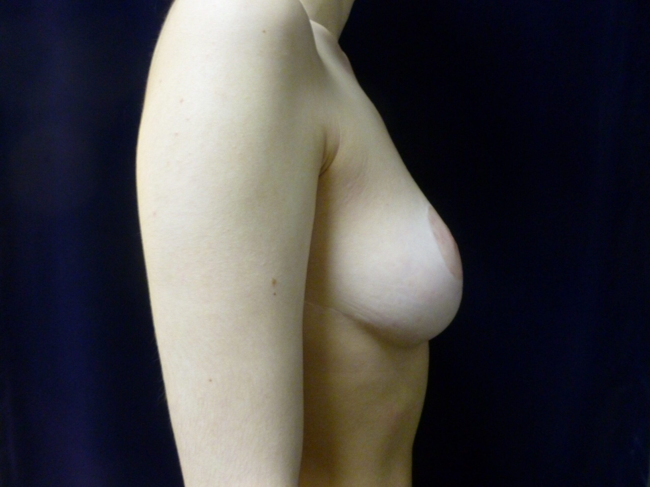 Breast Lift Patient Photo - Case 1958 - after view-2