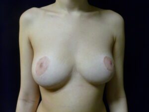 Breast Lift - Case 1958 - After