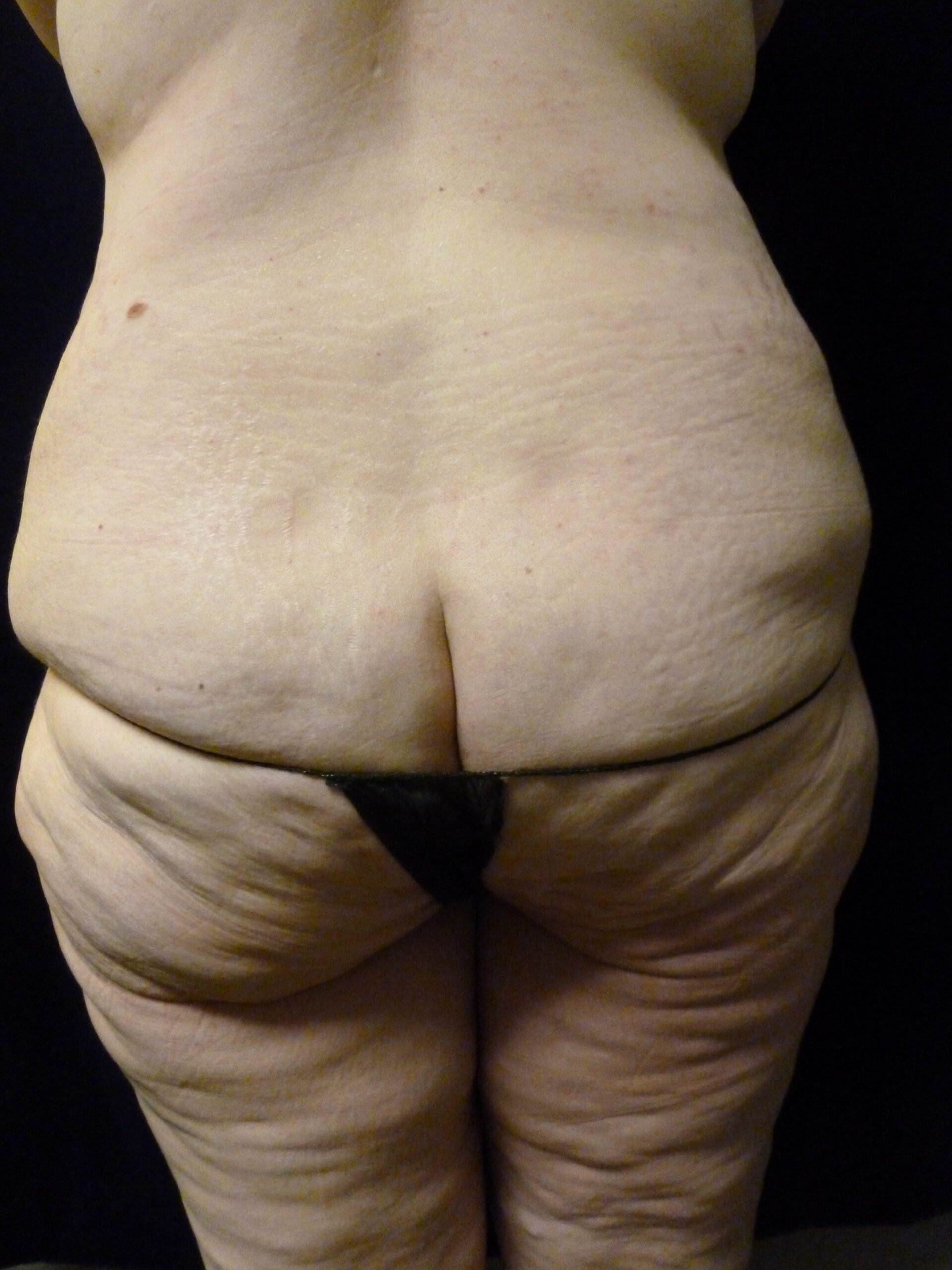 Tummy Tuck Patient Photo - Case 1969 - before view-1