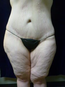 Tummy Tuck - Case 1969 - After