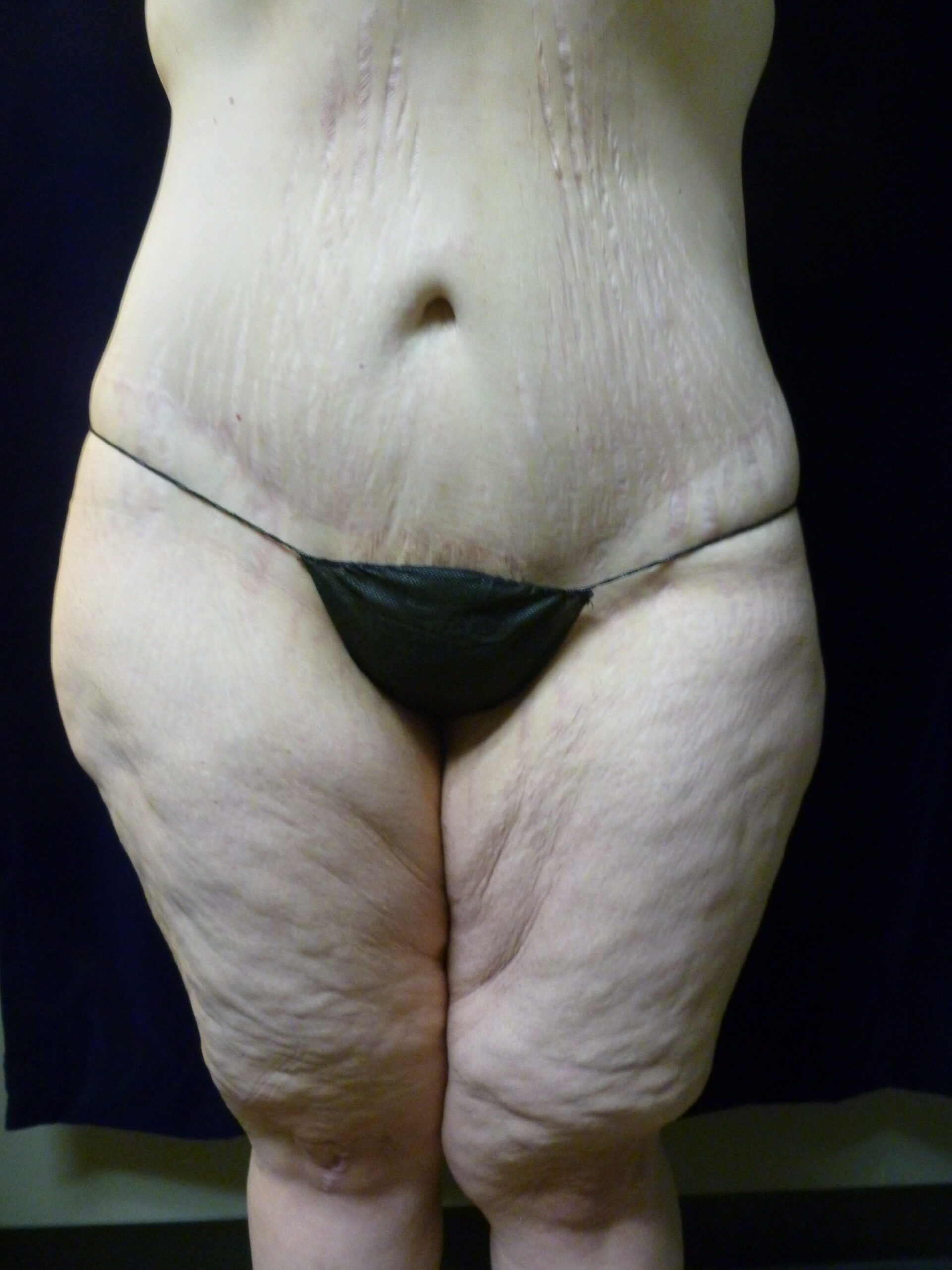 Tummy Tuck Patient Photo - Case 1969 - after view