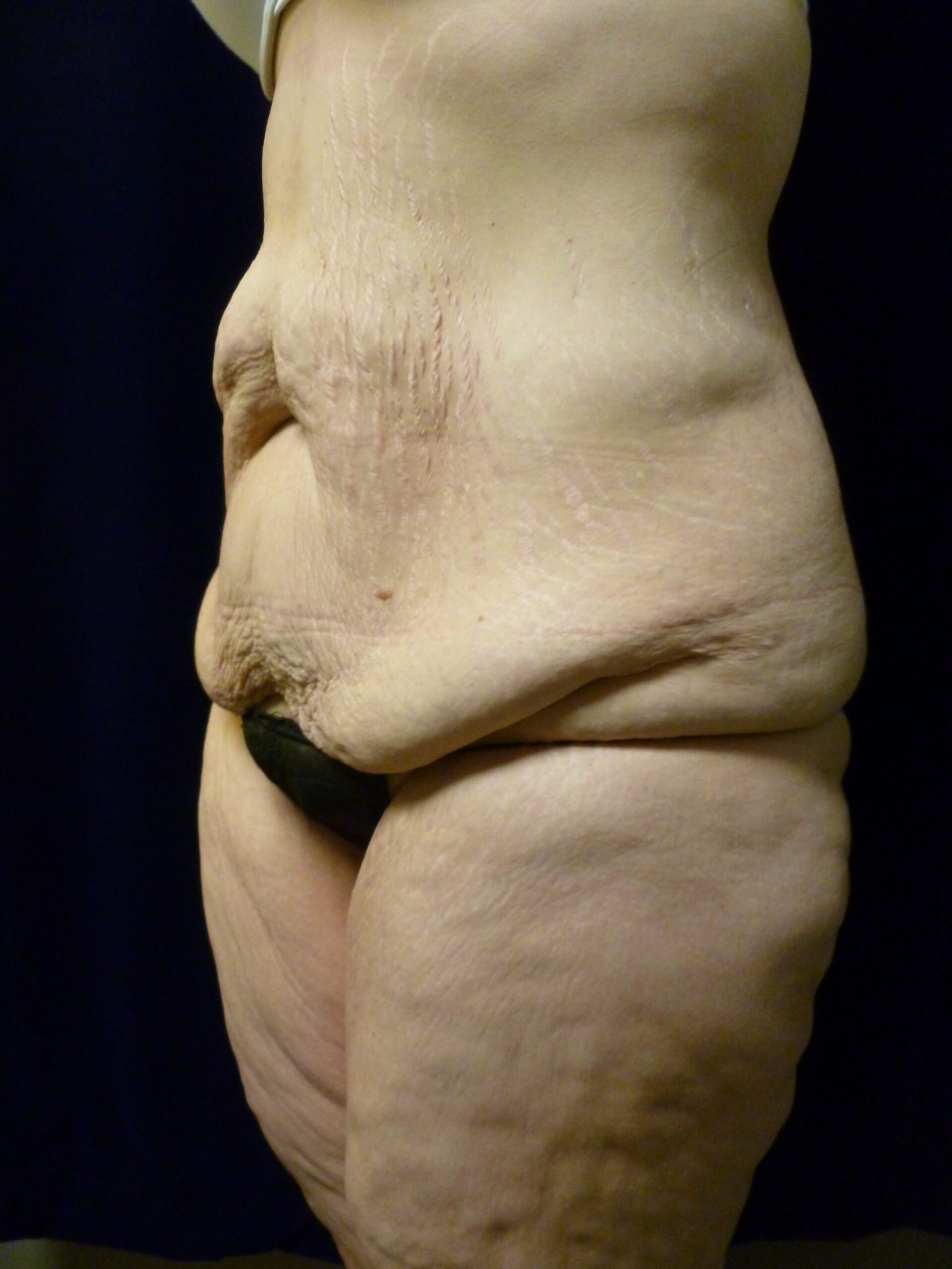 Tummy Tuck Patient Photo - Case 1969 - before view-4
