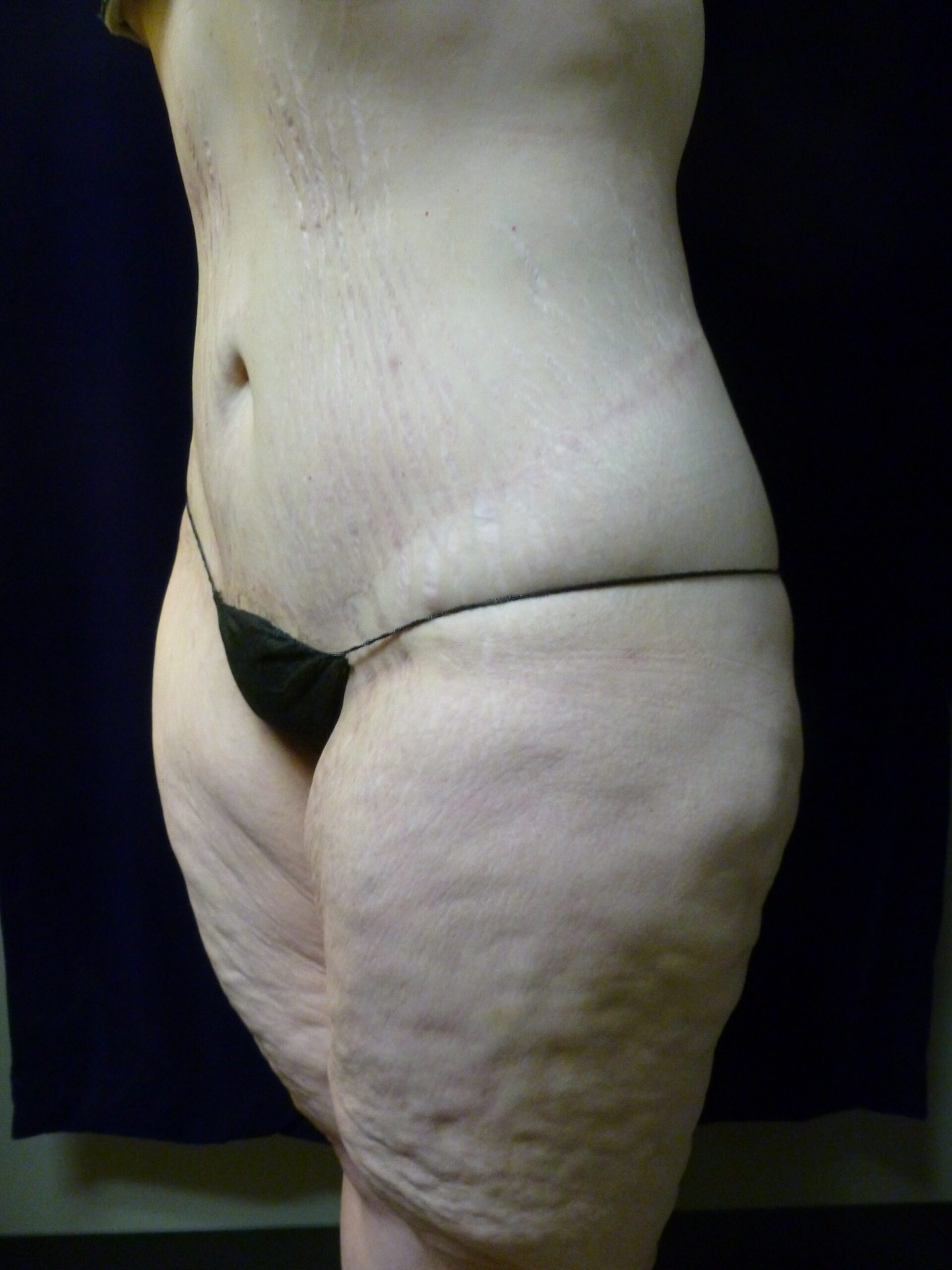 Tummy Tuck Patient Photo - Case 1969 - after view-4