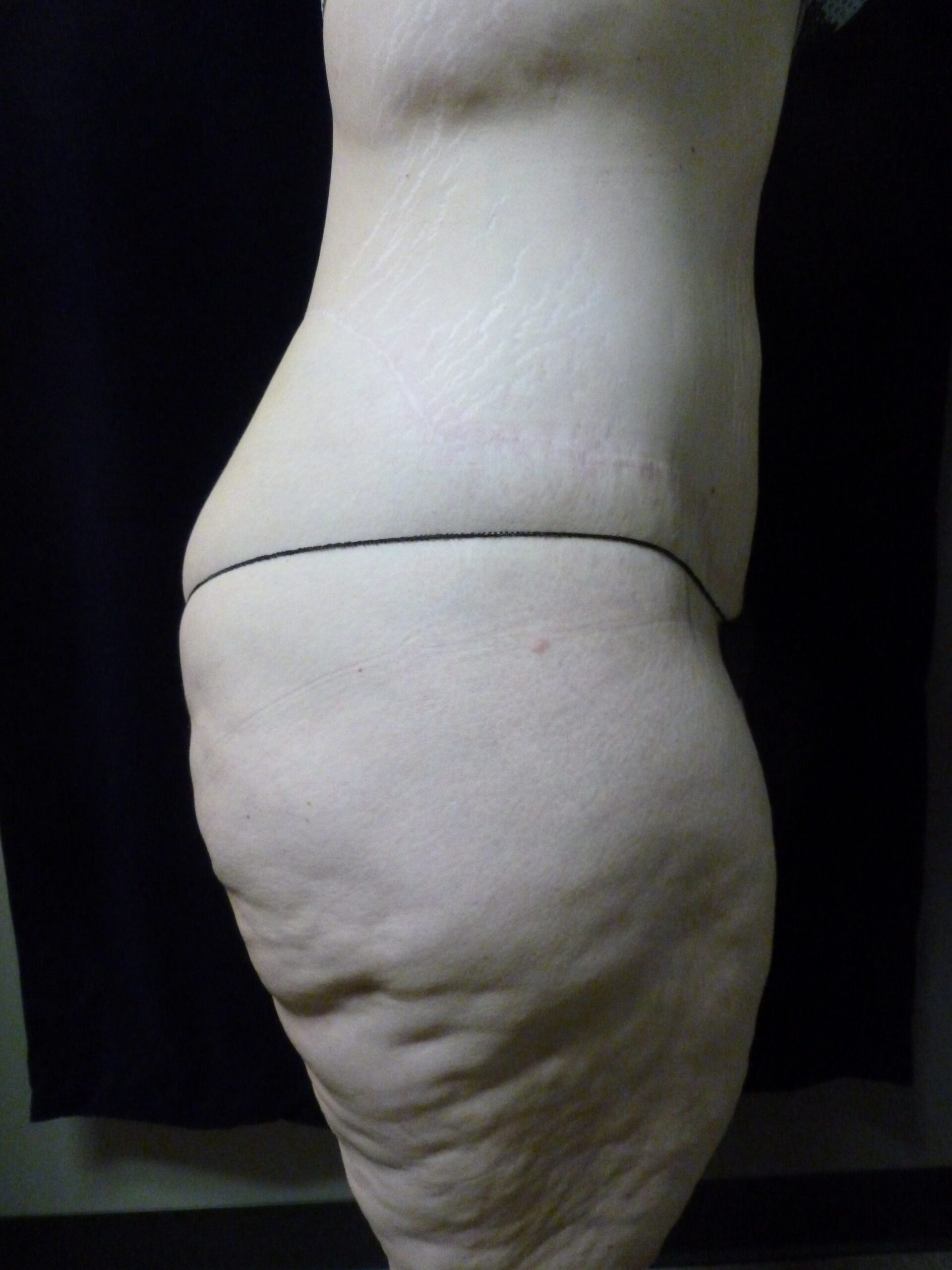 Tummy Tuck Patient Photo - Case 1969 - after view-2