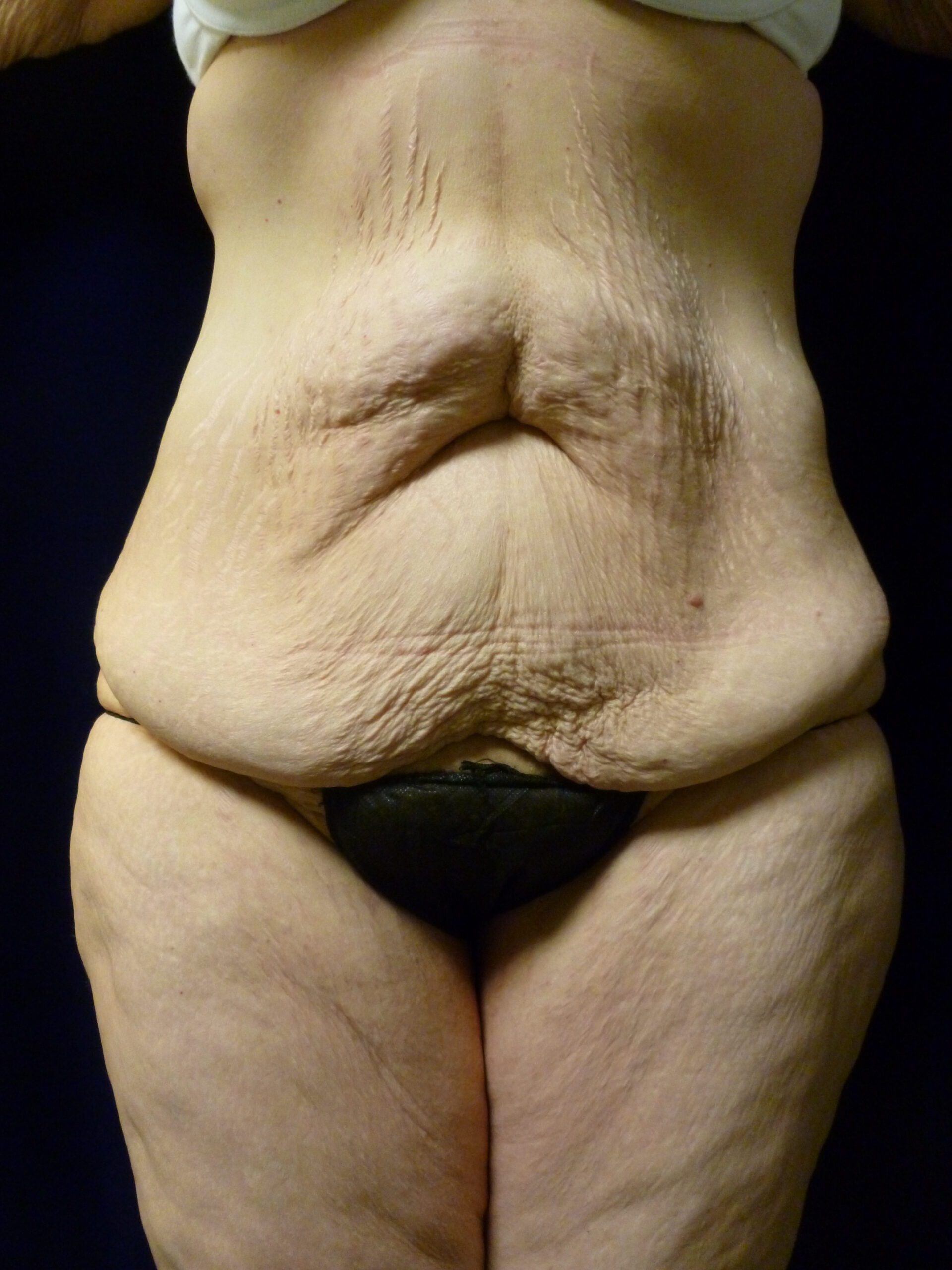 Tummy Tuck Patient Photo - Case 1969 - before view-
