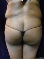 Liposuction - Case 1980 - Before