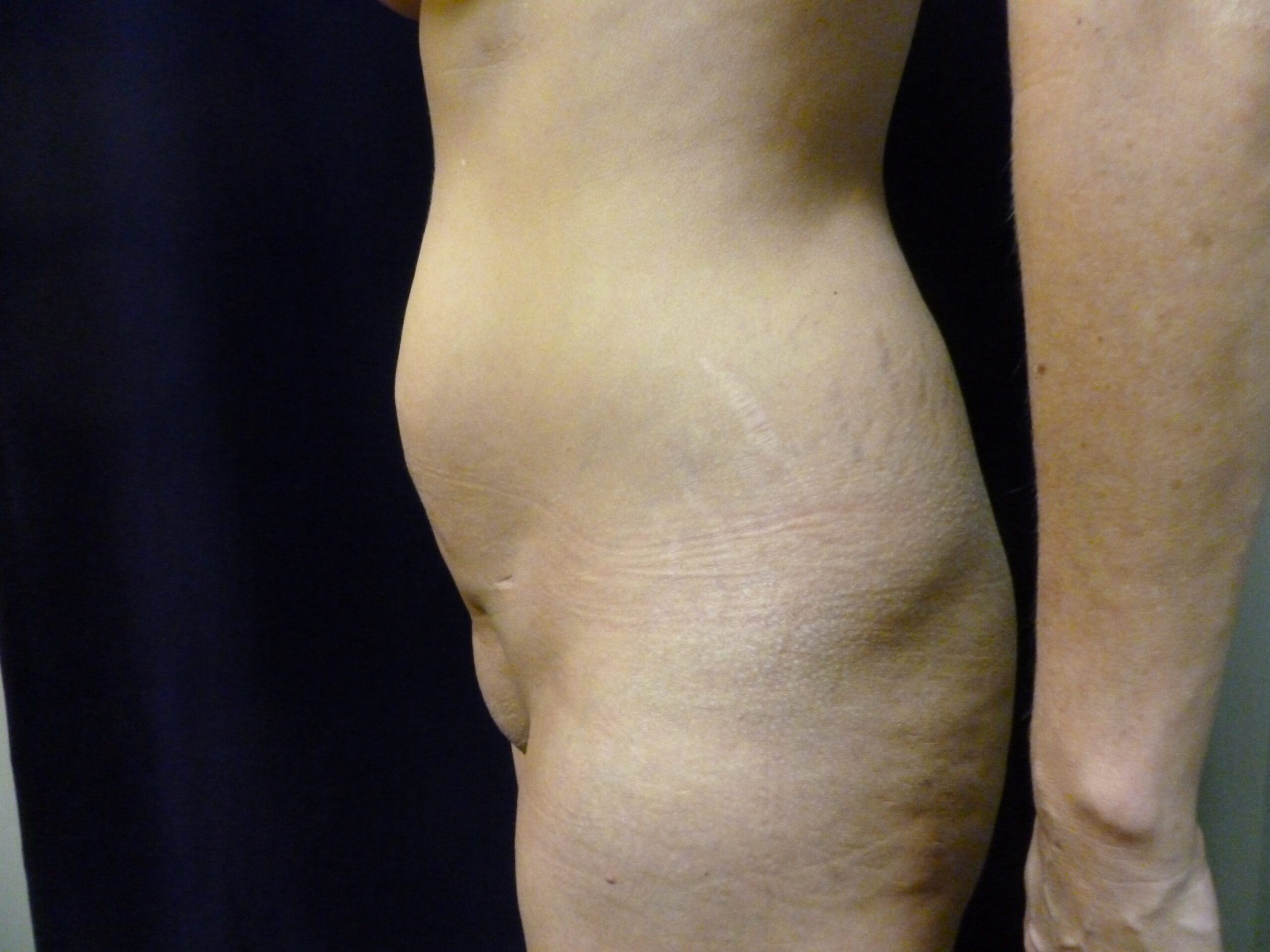 Liposuction Patient Photo - Case 1996 - before view-4