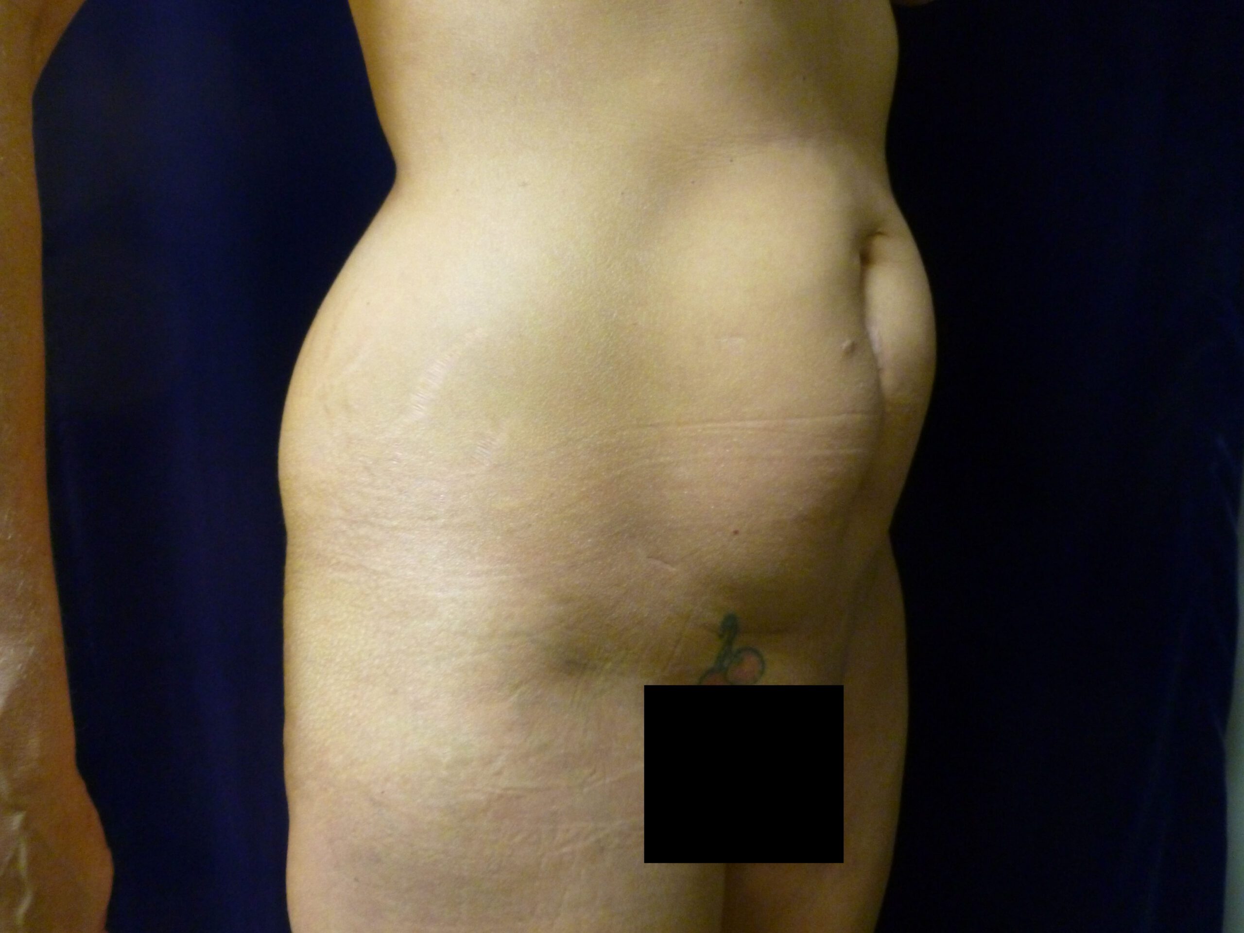Liposuction Patient Photo - Case 1996 - before view-2
