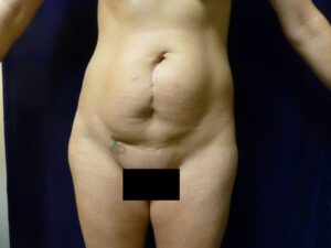 Liposuction - Case 1996 - Before