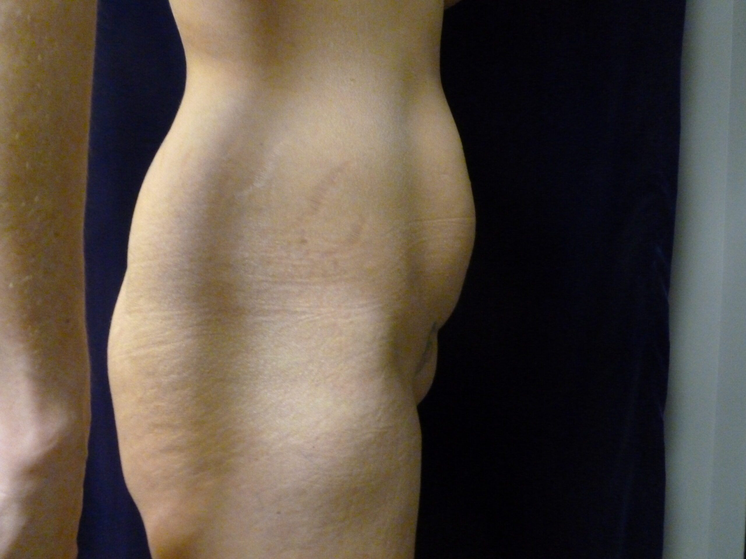 Liposuction Patient Photo - Case 1996 - before view-1