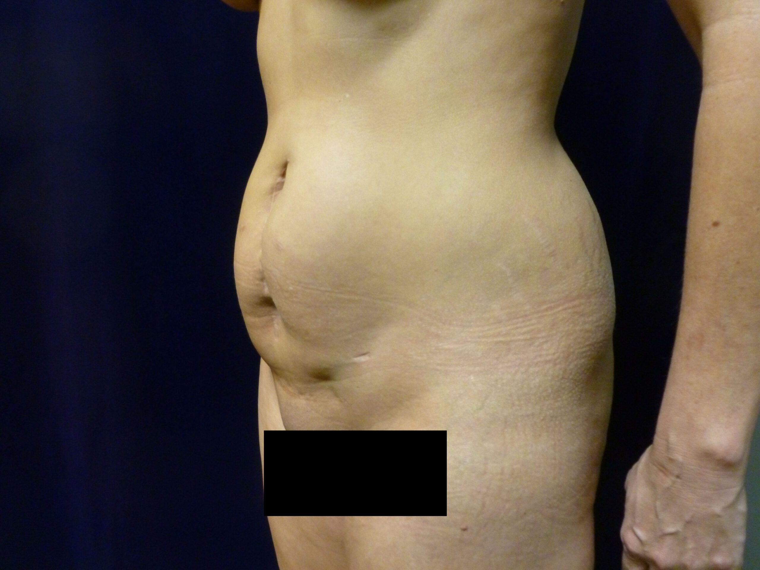Liposuction Patient Photo - Case 1996 - before view-3