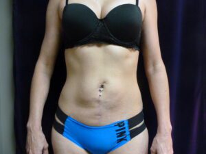 Liposuction - Case 1996 - After