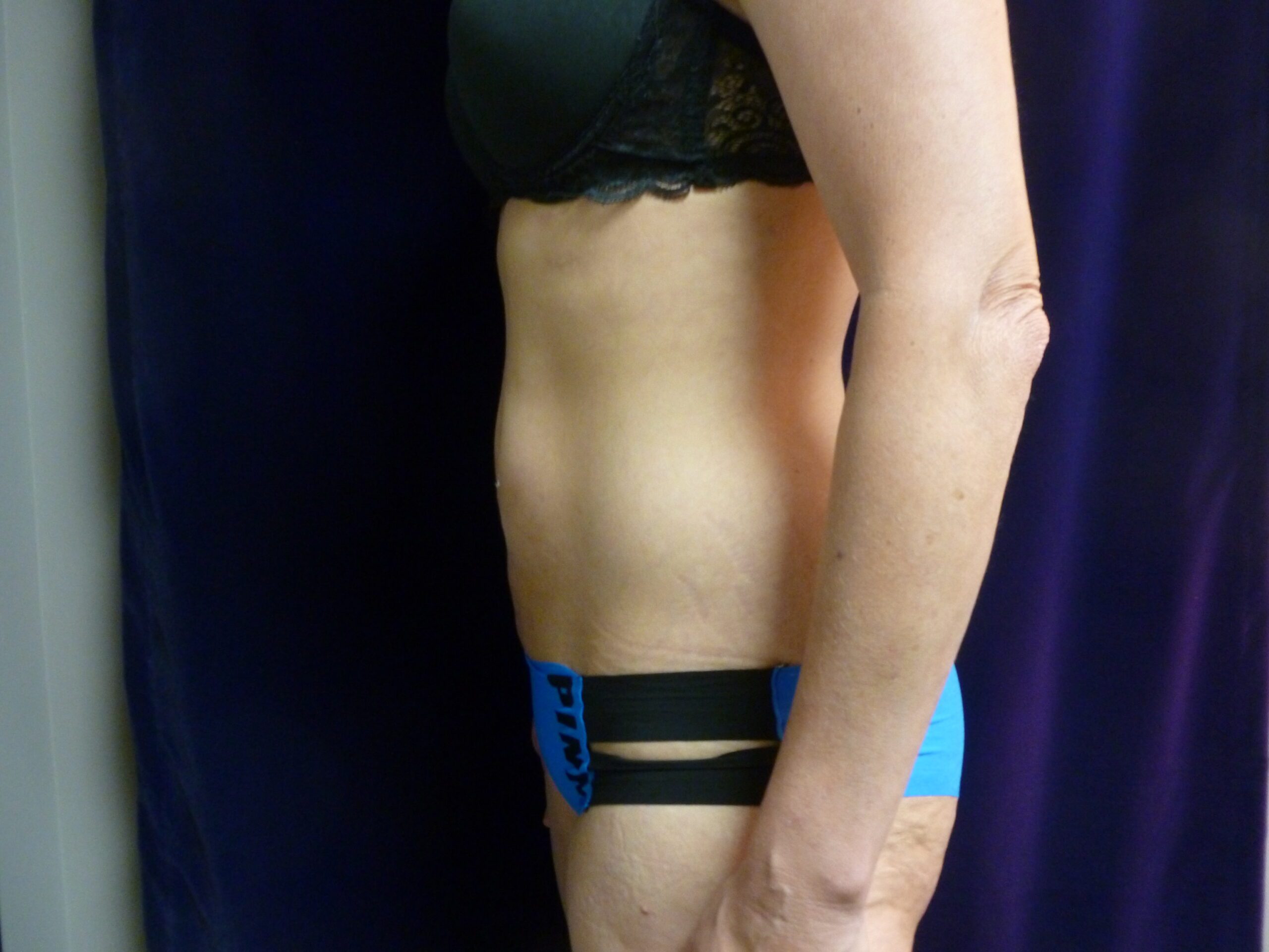 Liposuction Patient Photo - Case 1996 - after view-4